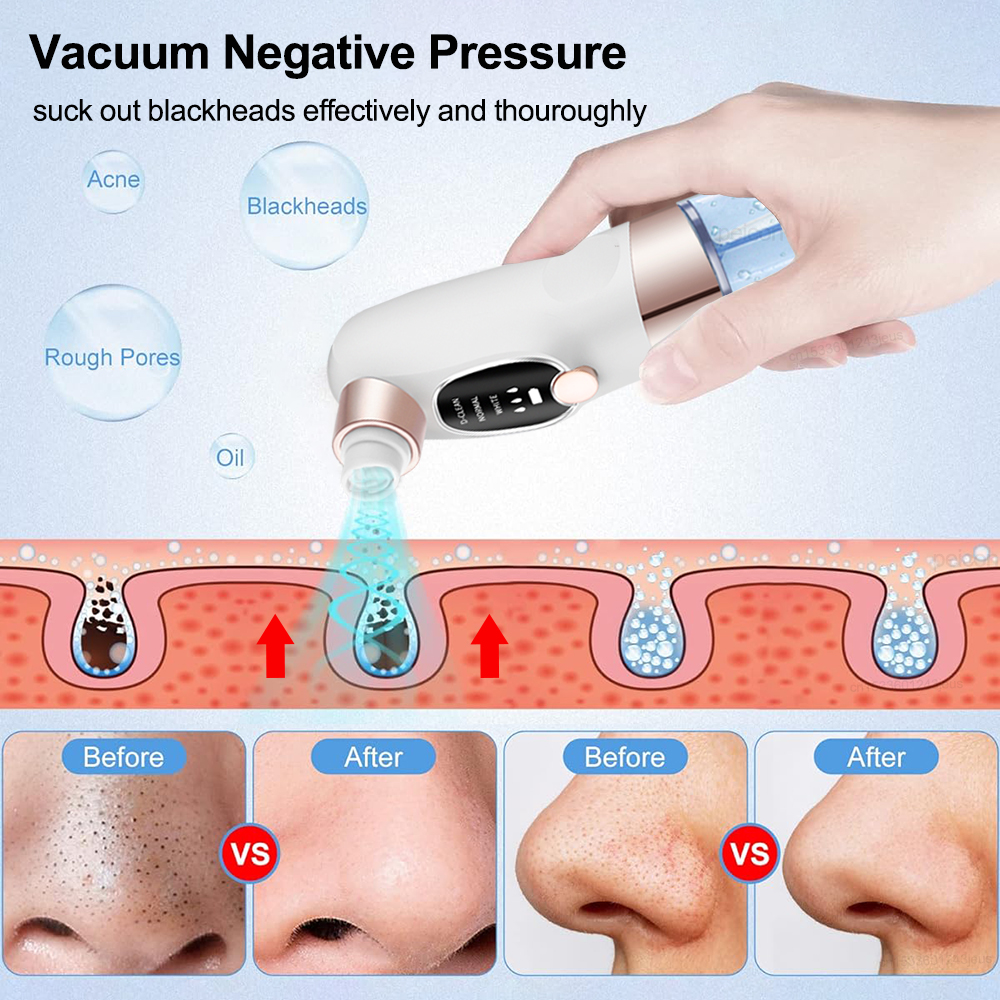 Blackhead Remover Electric Bla - Pore Vacuum ulasan dan harga