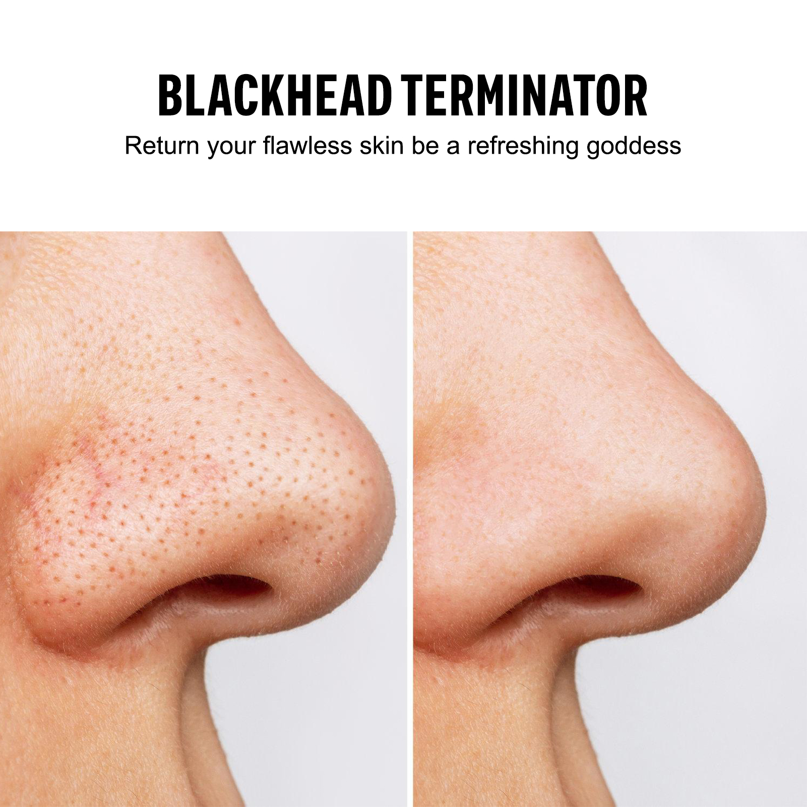 Blackhead Remover Vacuum Sucti - Pore Vacuum ulasan dan harga