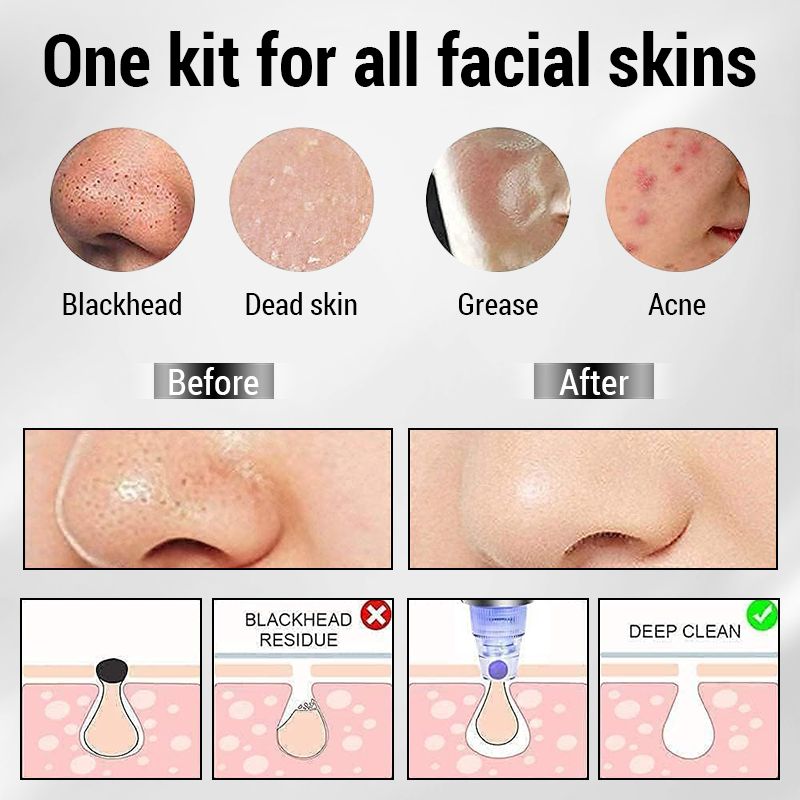 3 IN 1 Suction Blackheads God  - Pore Vacuum ulasan dan harga